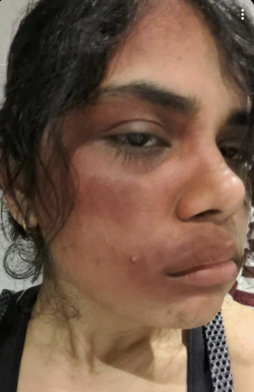 Akshaya Anand after the attack.