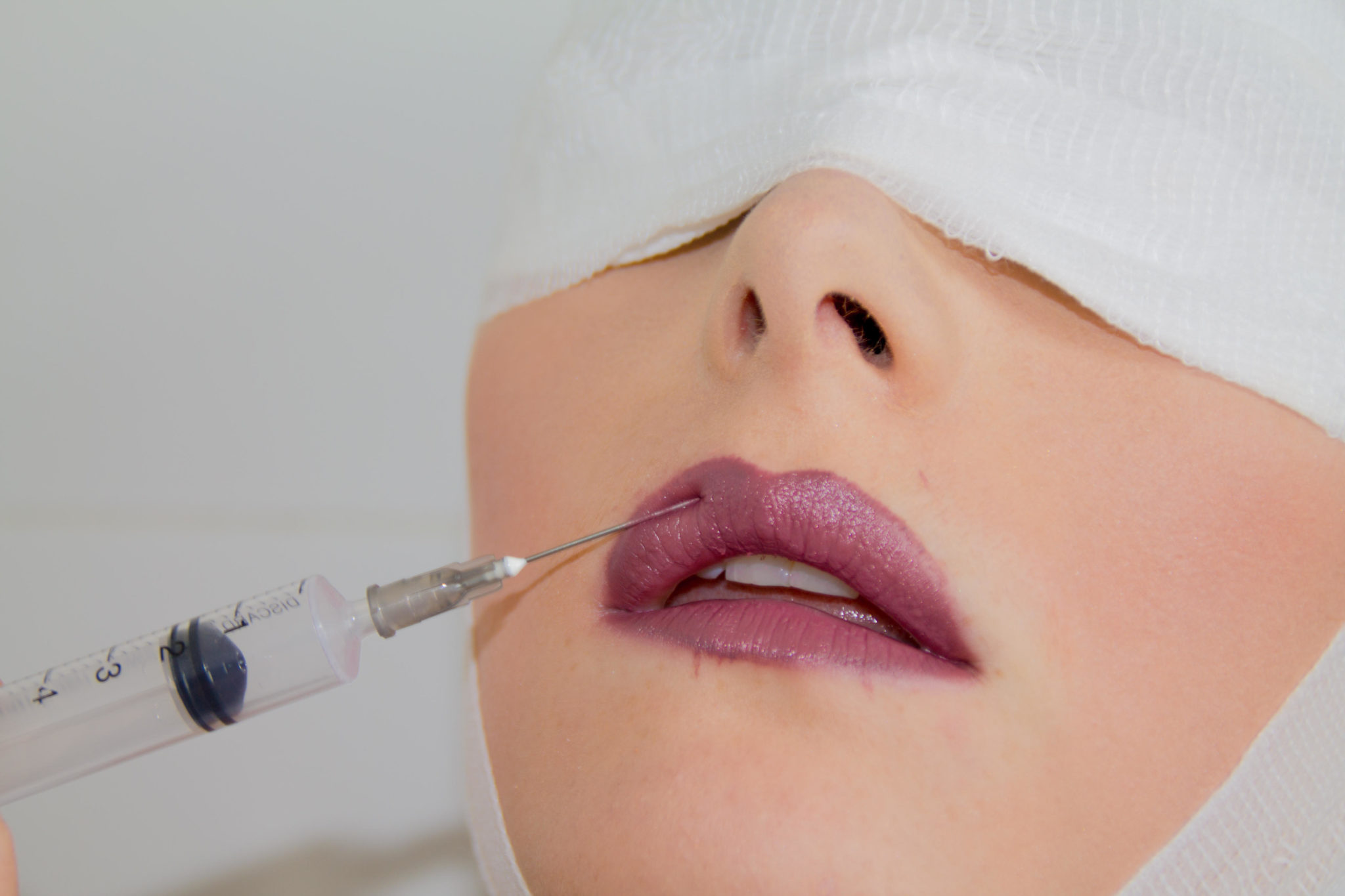 Plastic surgery lip injection face botox. Image: Eyesofalens / Alamy Stock Photo