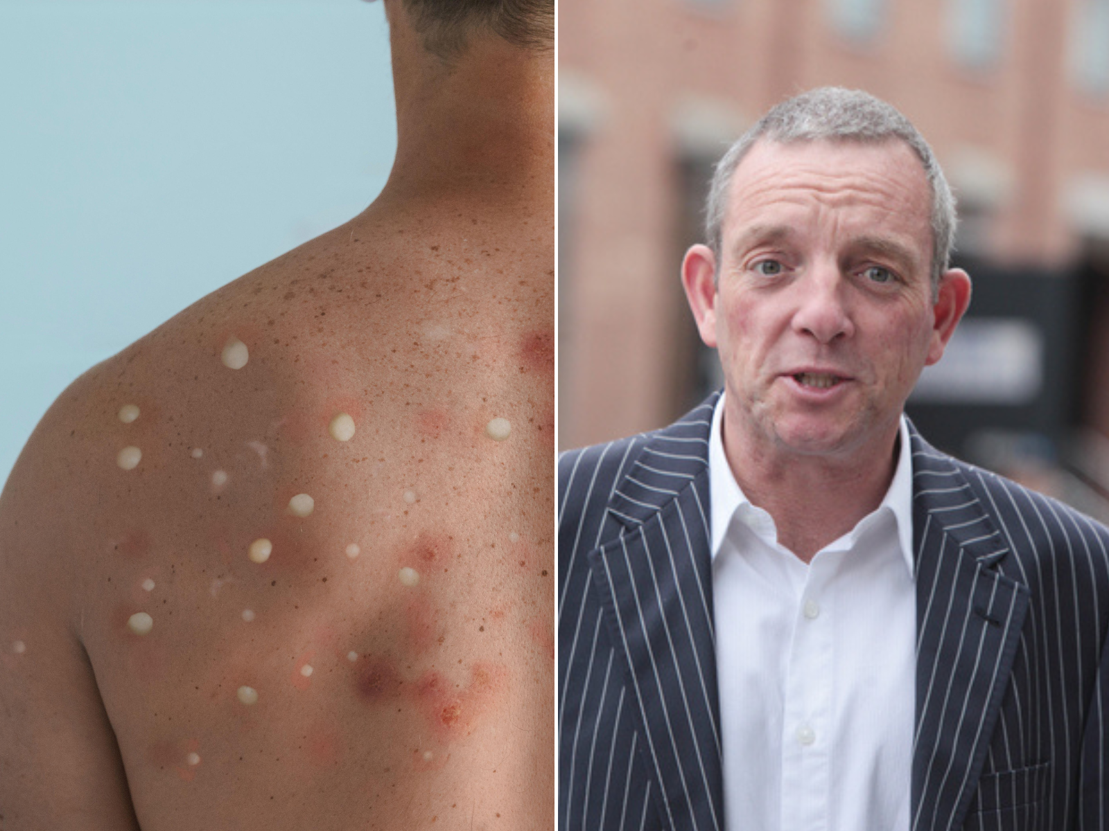 Monkeypox: 'All-government' approach needed - Senator Buttimer - Vimarsana News