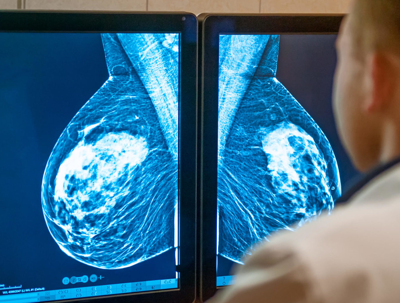 A doctor examines a mammogram snapshot of the breast of a female patient on monitors.