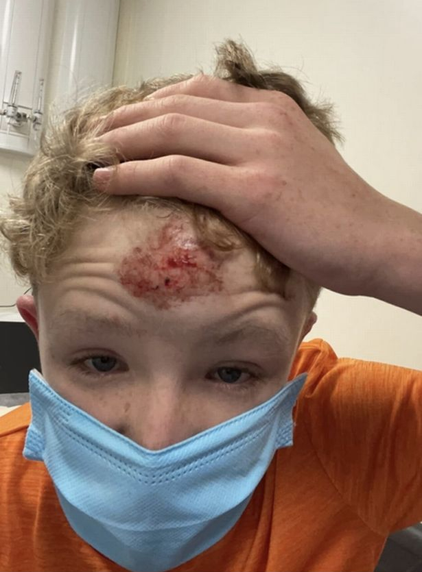 13-year-old Jack Duggan shows his head injury. Image: Duggan family.