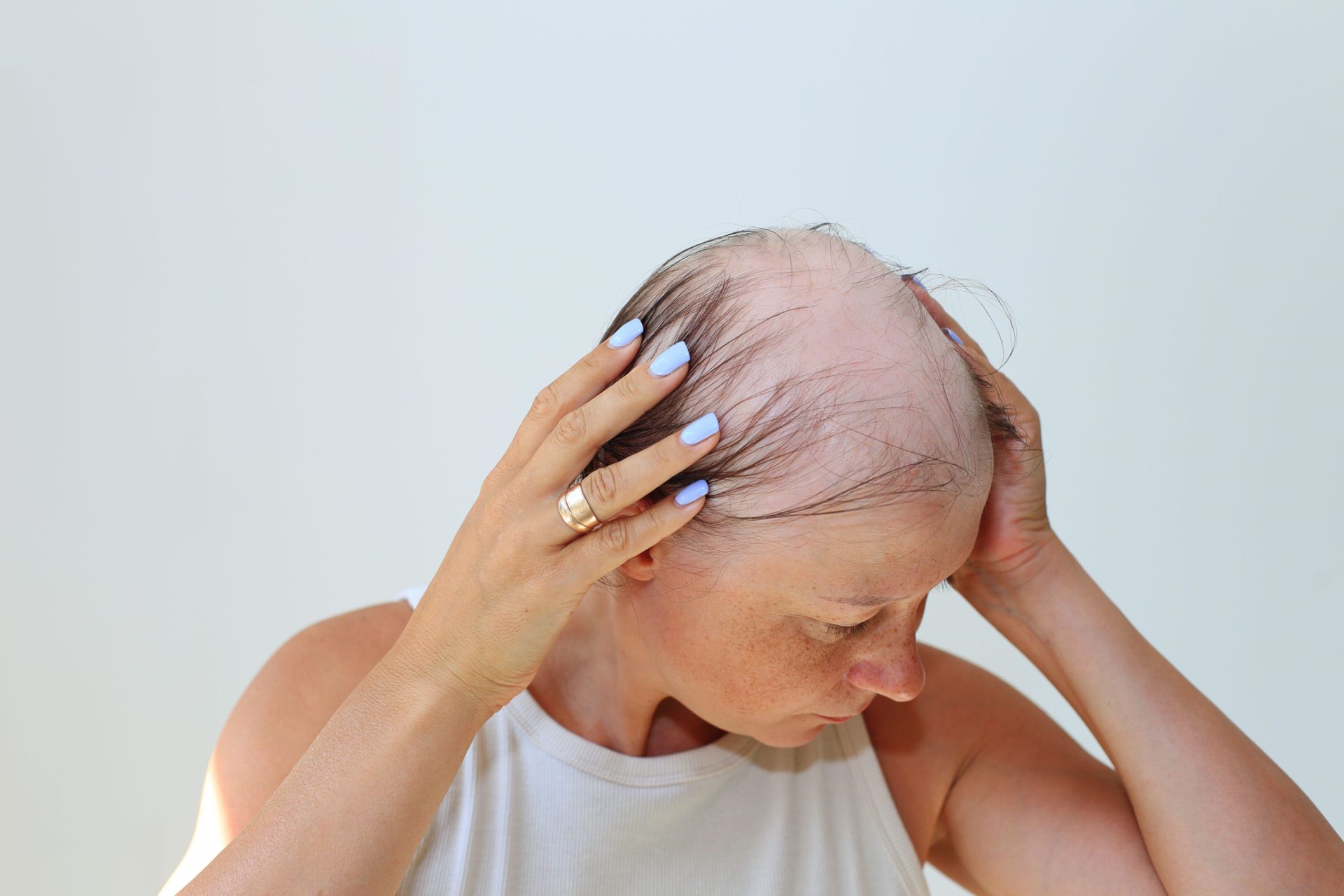 Hair loss in the form of alopecia areata
