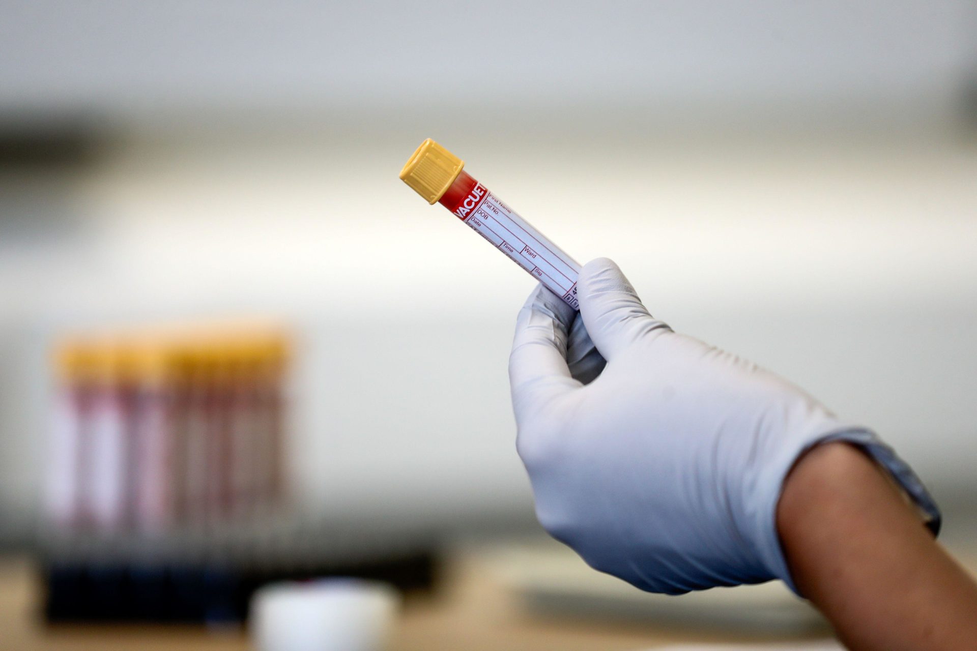 2NJPKF6 File photo dated 05/06/2020 of a test tube containing a blood sample, as prostate cancer screening may be a step closer after a study suggested that harms linked to testing have reduced thanks to advances in medical technology.