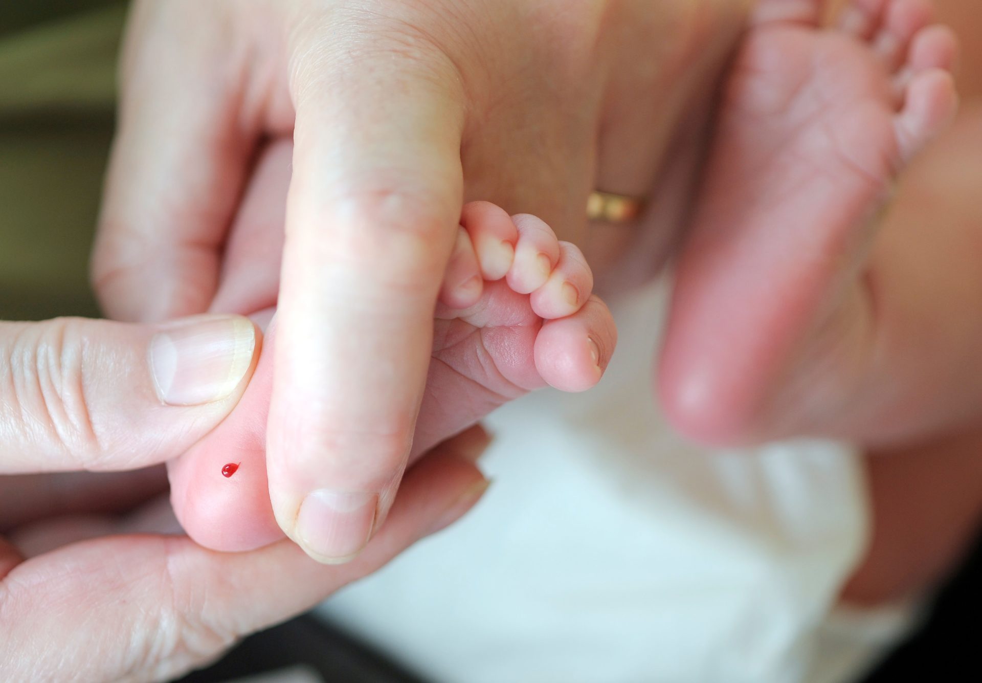 A heel prick test on a newborn baby