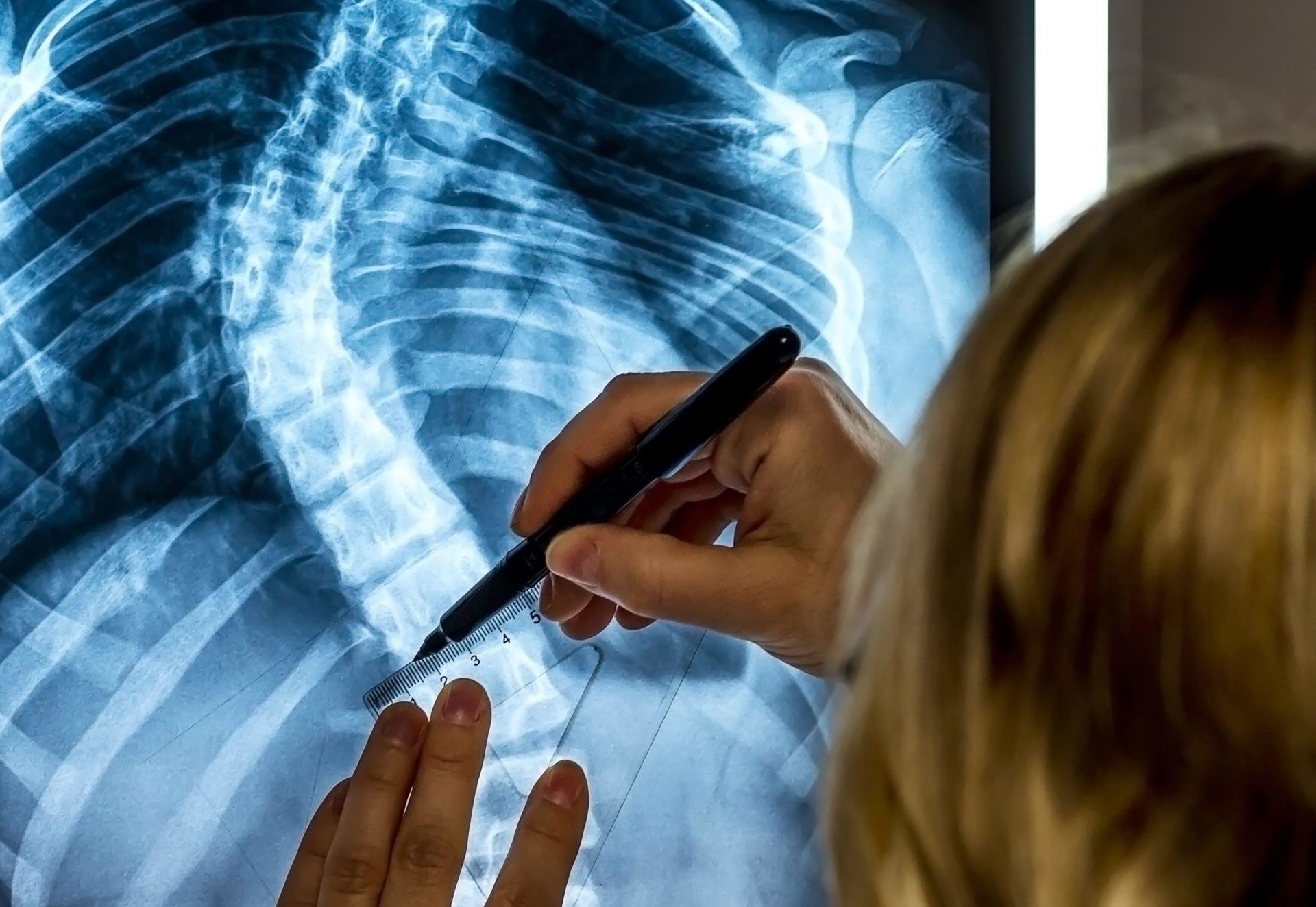 A scoliosis specialist physician looking at a patient's x-ray