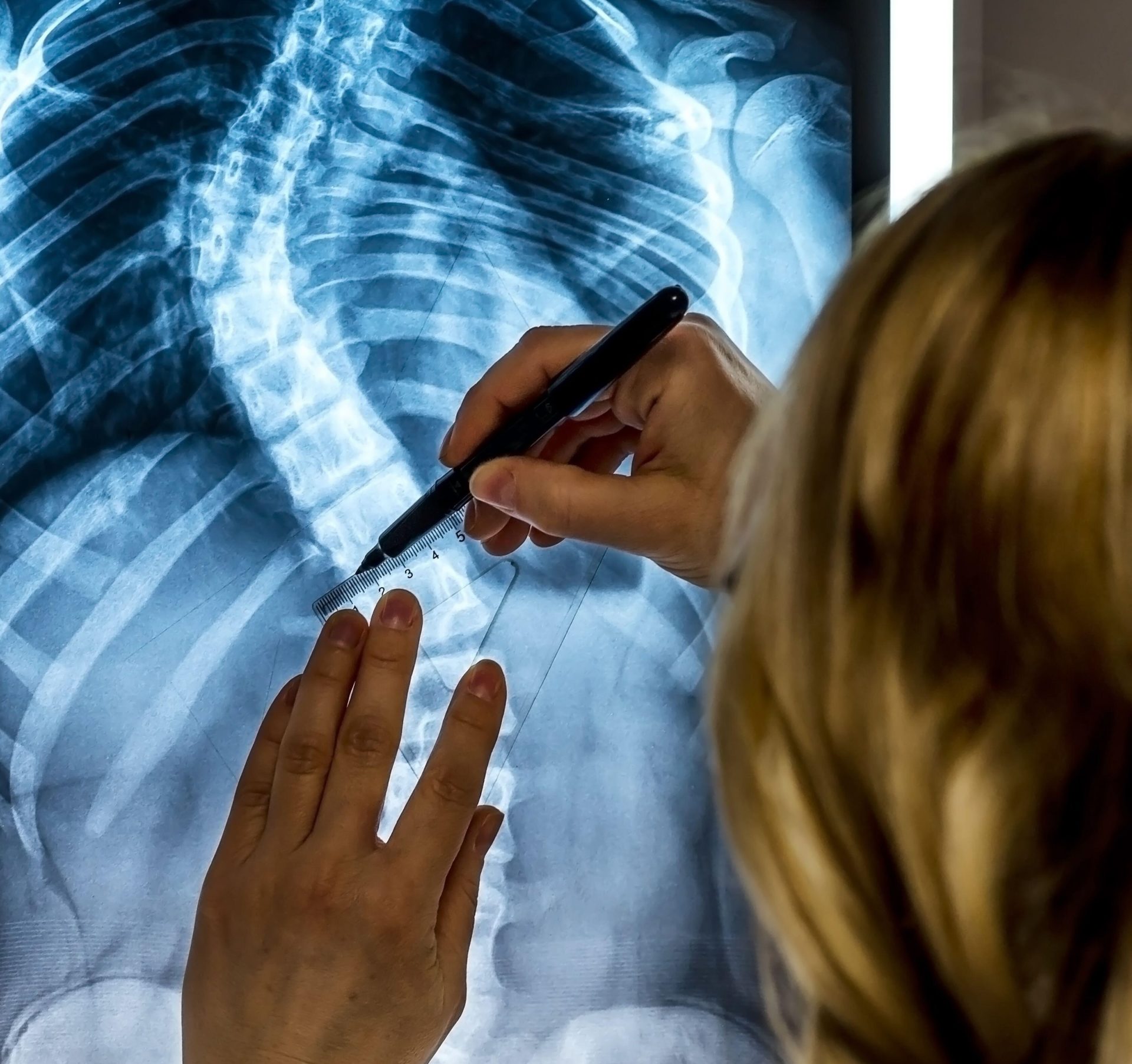 A scoliosis specialist physician looking at a patient's x-ray