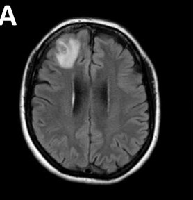 A magnetic resonance image of the patient's brain shows a right frontal lobe lesion.