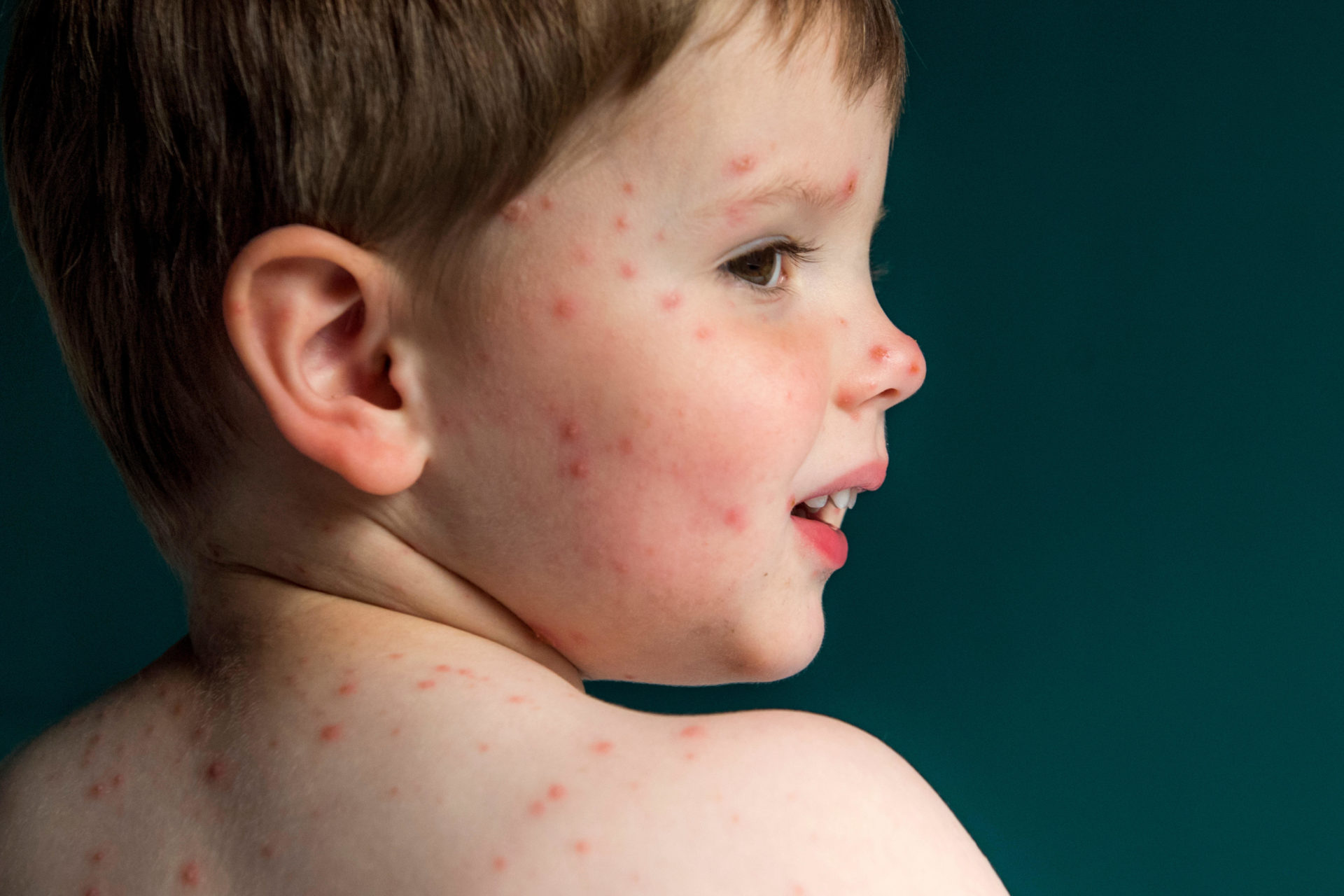 A two year old boy suffers from Chickenpox. also known as varicella