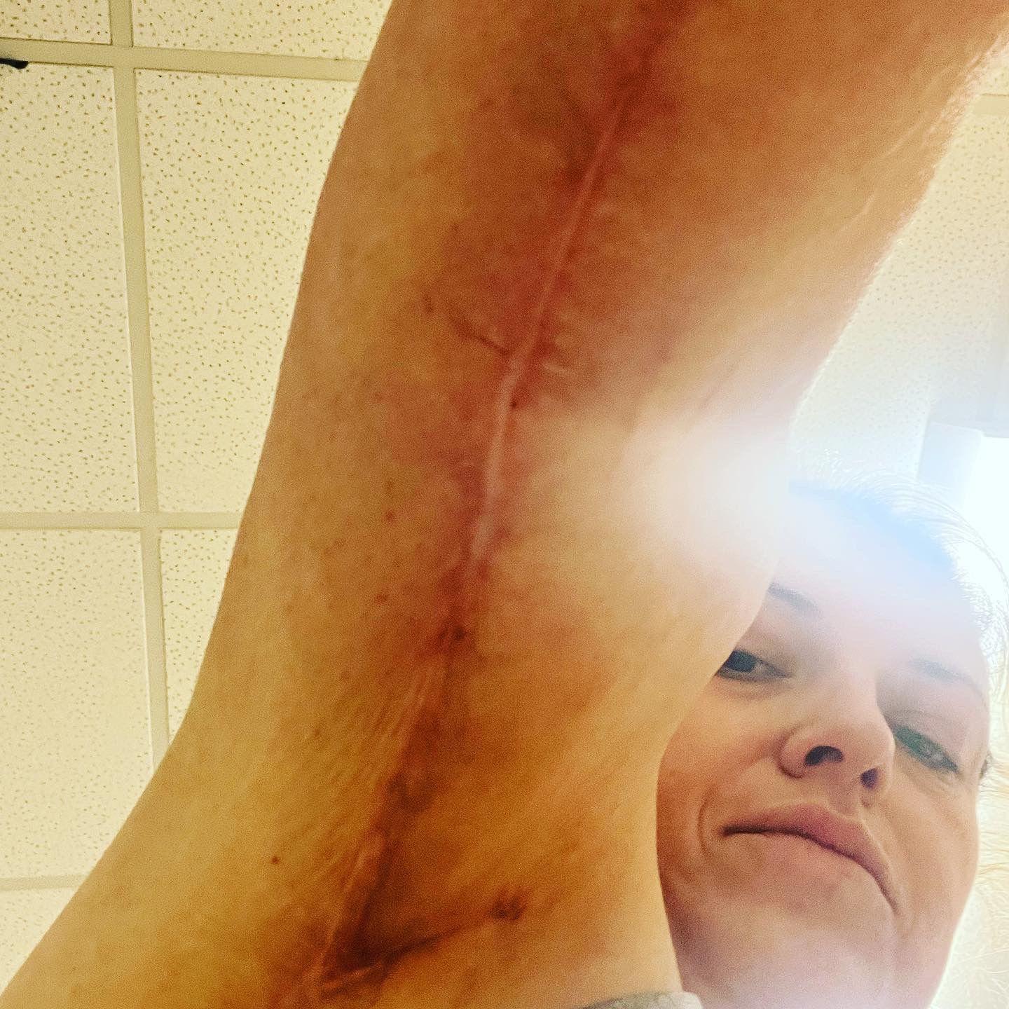 Sarah Platt shows off scarring from botched surgery in Turkey