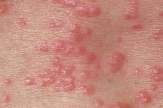 The scabies rash spreads and turns into tiny red spots.