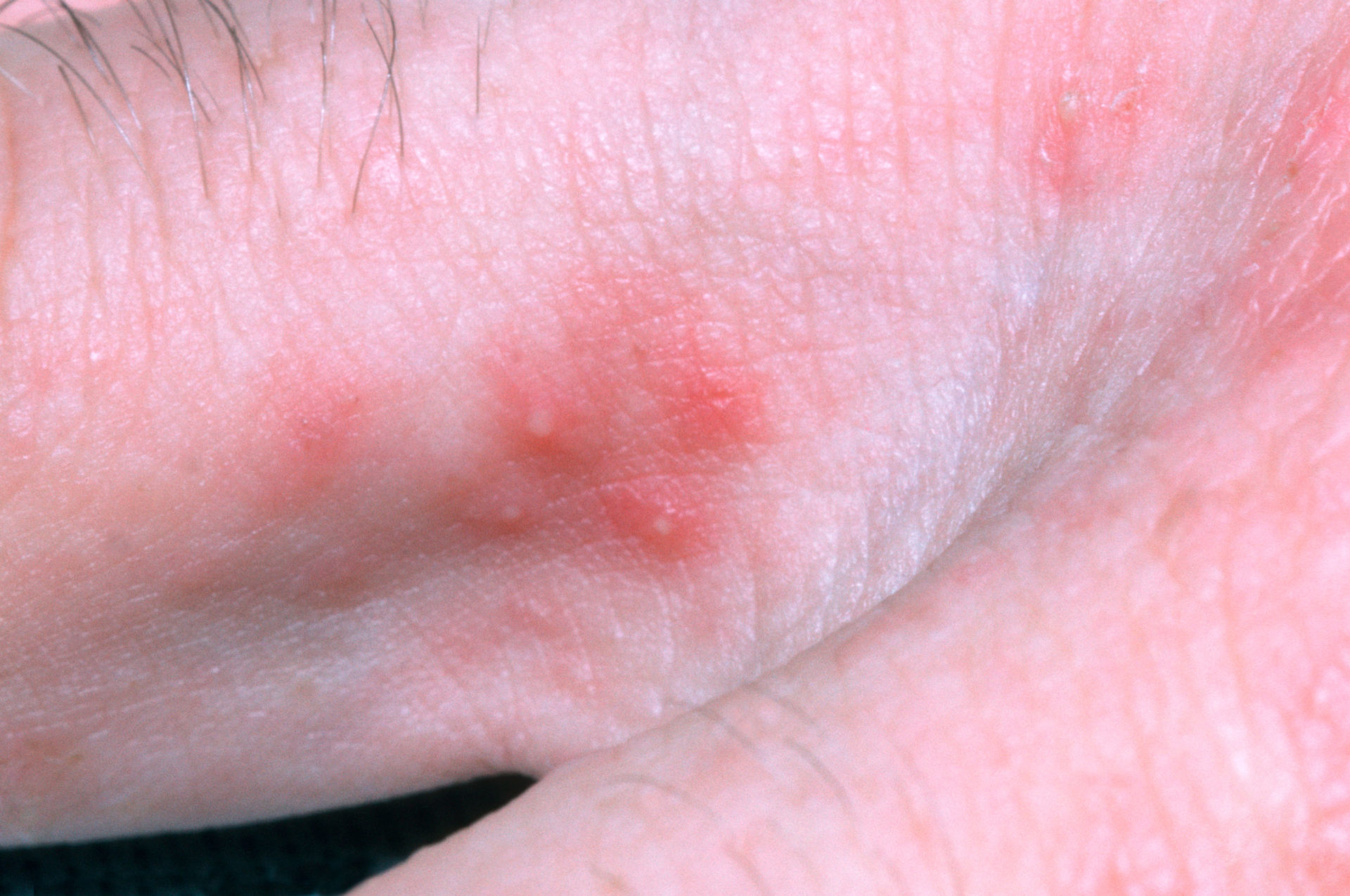 Very Concerning Scabies Cases Doubled In 2024 Newstalk very-concerning-scabies-cases-doubled-in-2024-newstalk