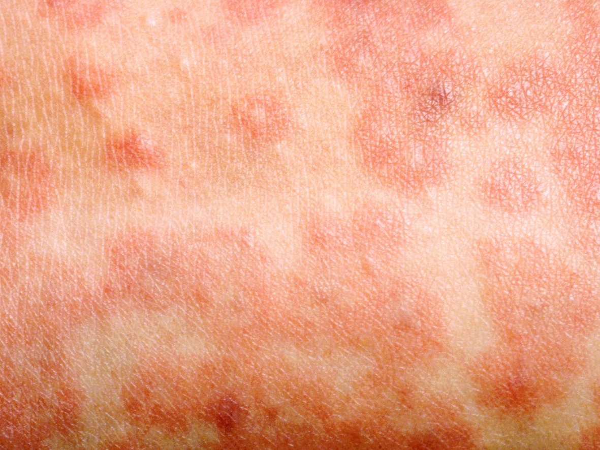 A person's chest with the small red-brown spots of a measles rash.