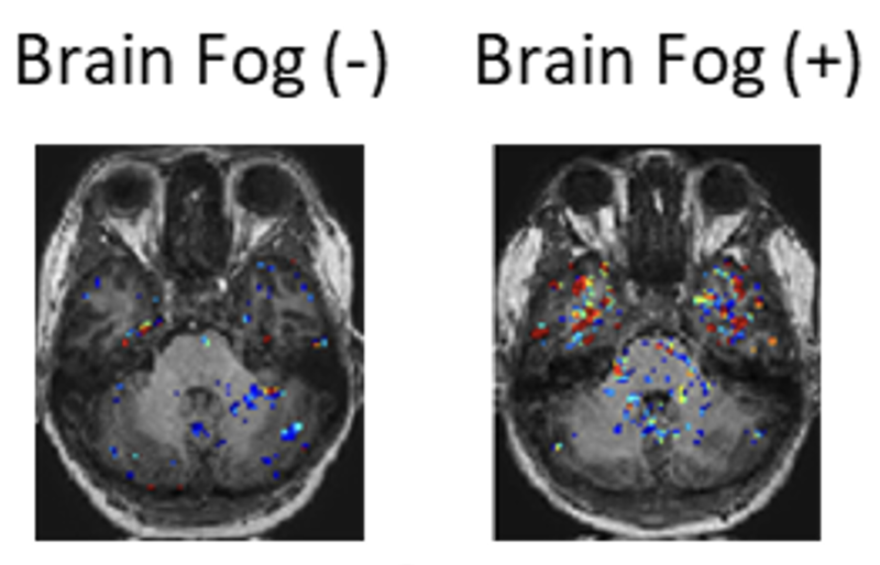 MRI scans in patients with Long COVID with or without brain fog. Increased 'leakiness' of the blood vessels is seen in those patients with brain fog