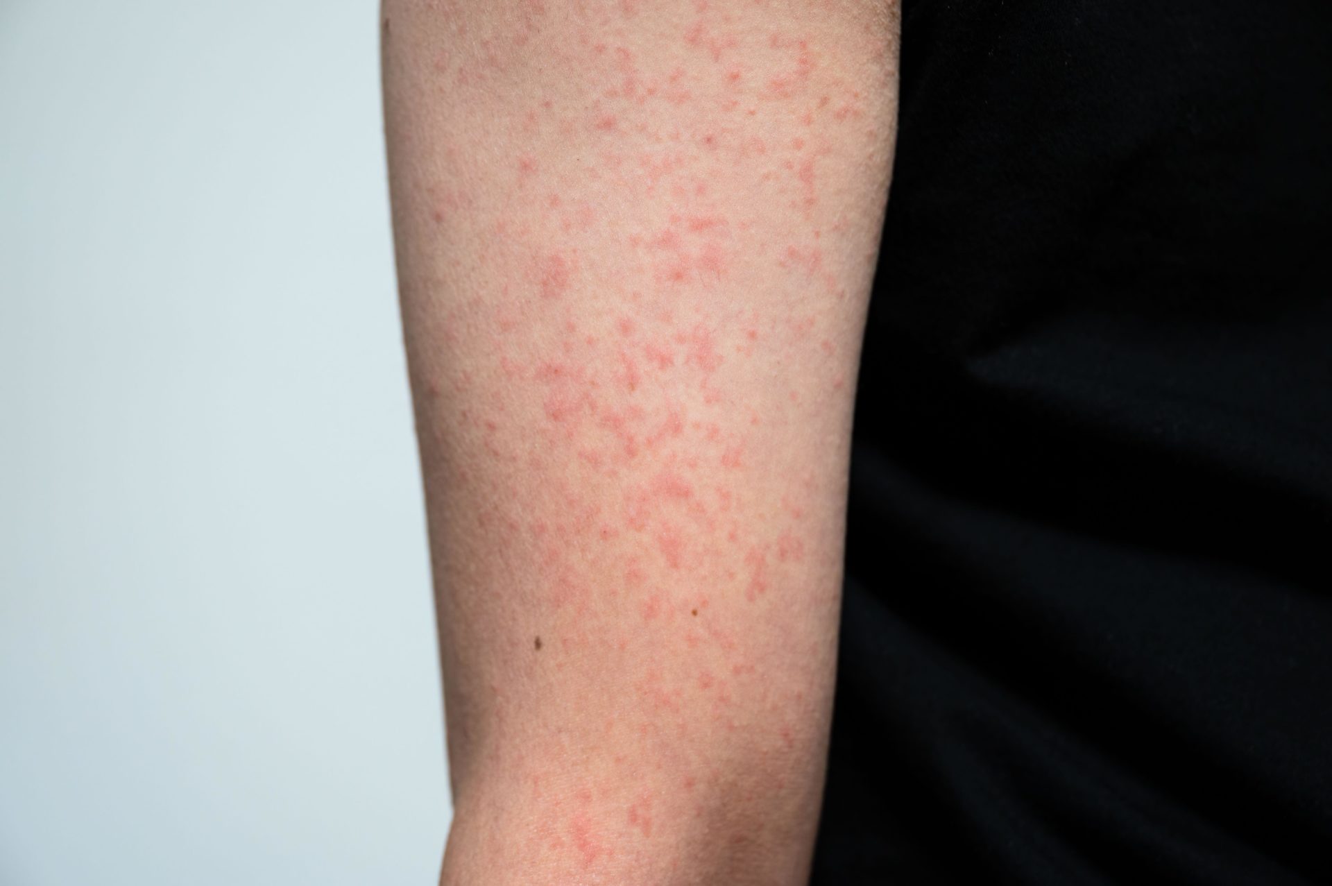 The arm of a patient with measles.