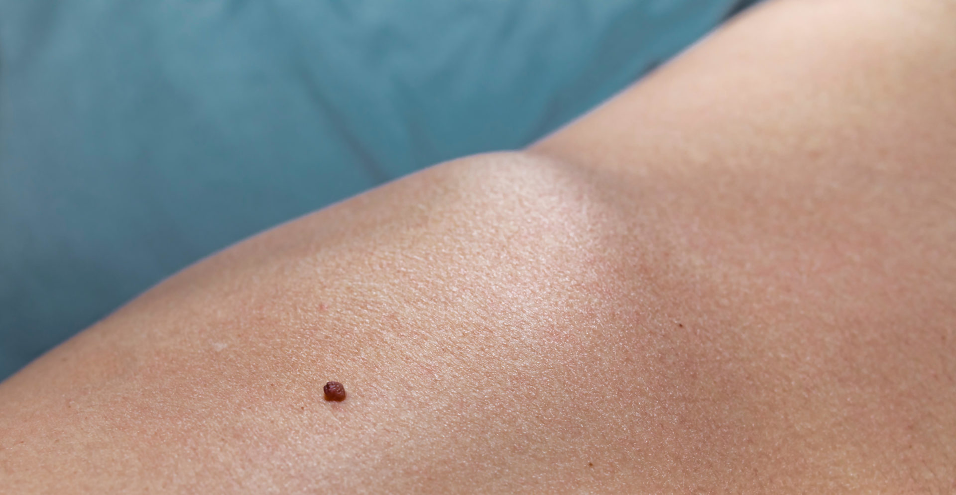Close up shot of a brown raised skin mole, which can be a cause for melanoma. Image: Kurt Pacaud / Alamy Stock Photo