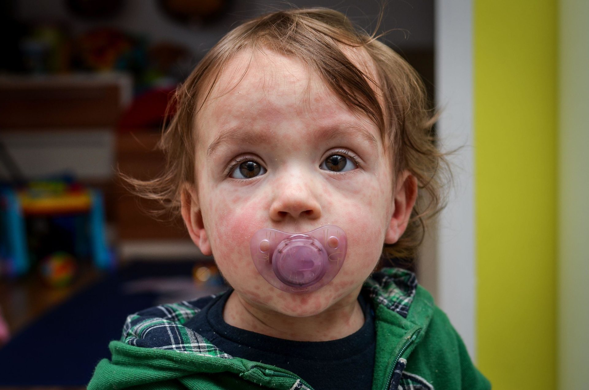 Child with measles. Image: Jure Gasparic / Alamy Stock Photo 