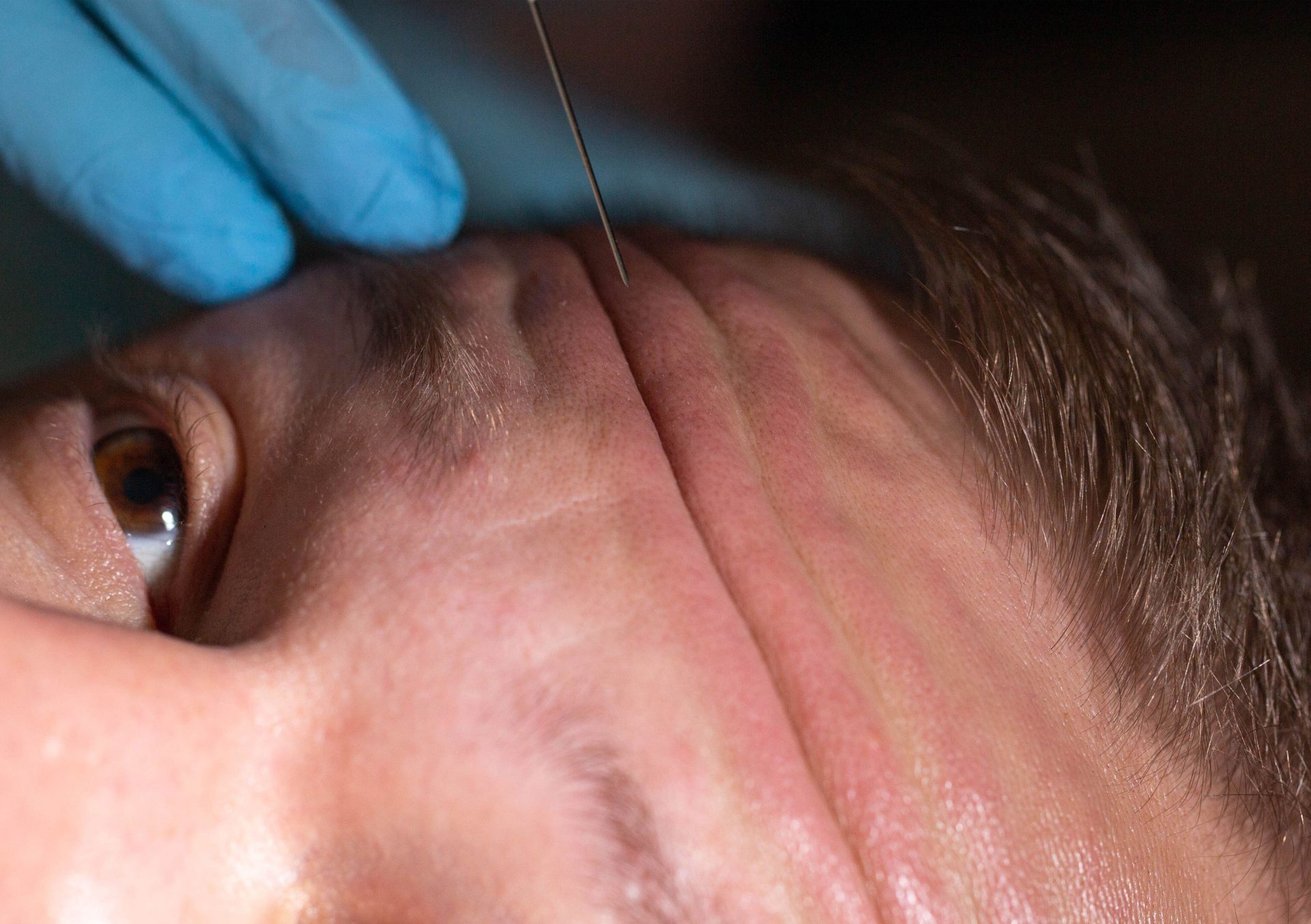 Doctor cosmetologist makes injections into the forehead against mimic wrinkles. 