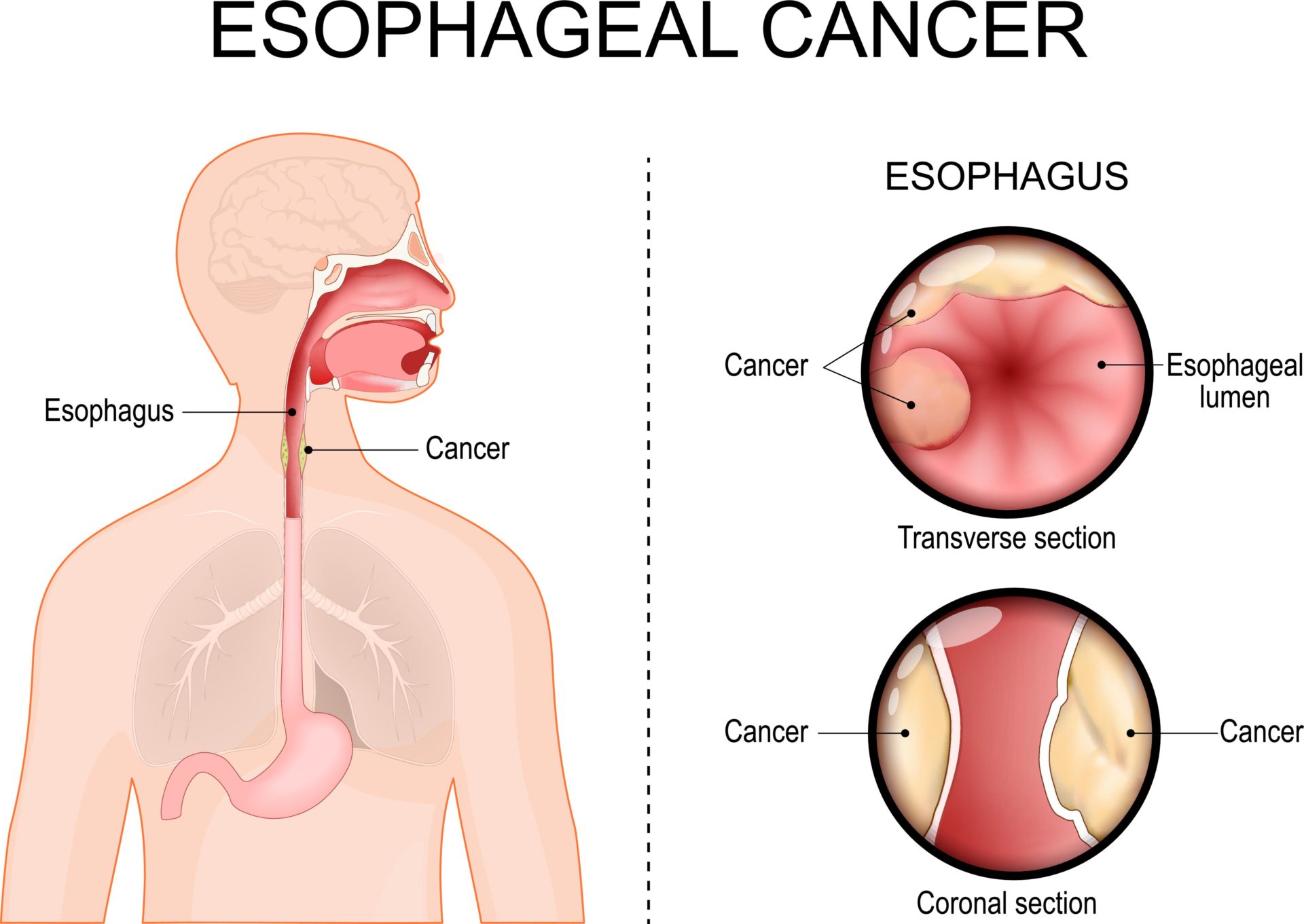 2S81RHT Esophageal cancer. Transverse section and Coronal section of Esophagus. Adenocarcinoma. Close-up of a Esophageal Lumen. Human silhouette with stomach,