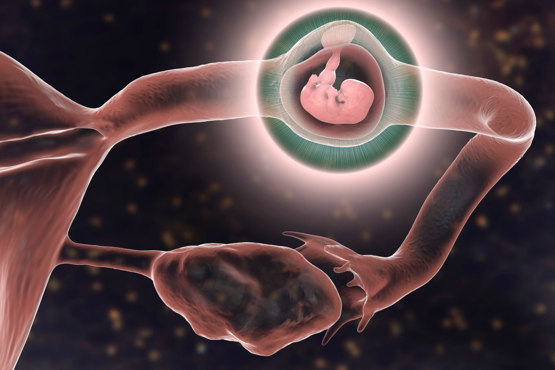 Ectopic pregnancy, illustration.