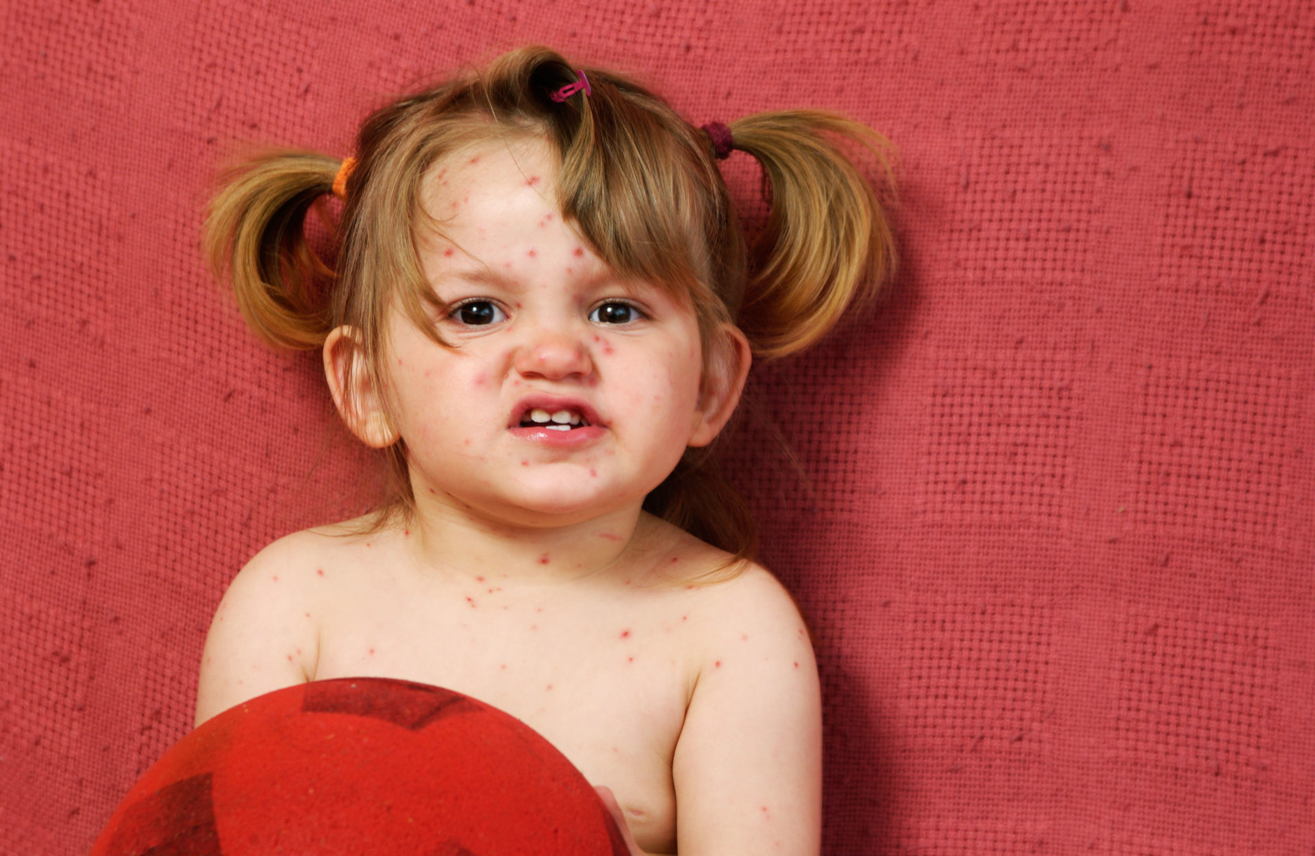 AGN4EA girl chicken pox